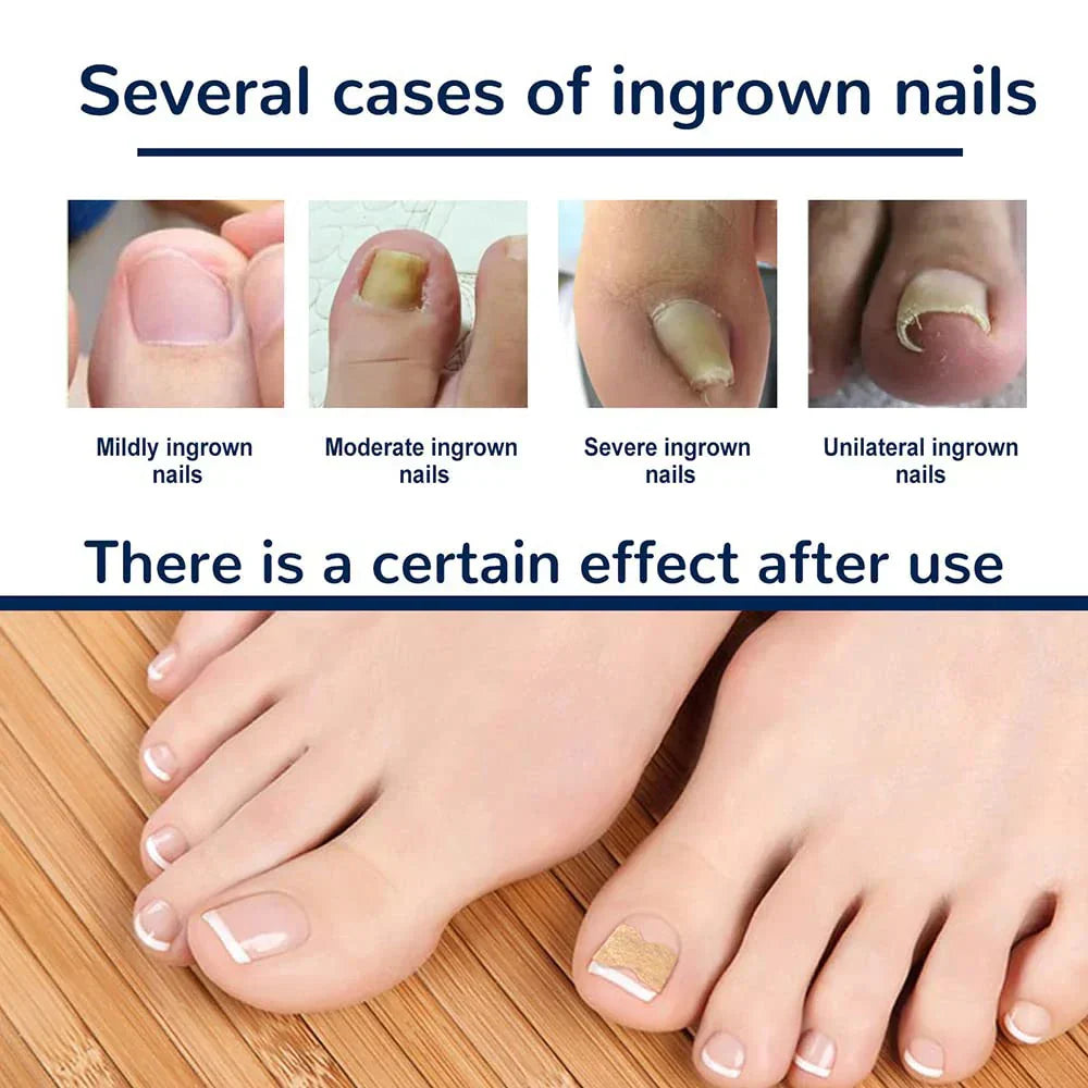NagelVital Pro - Pflegeaufkleber für Nagelkorrekturen | 50% RABATT