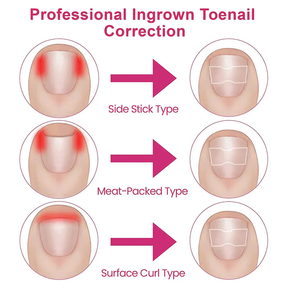 NagelVital Pro - Pflegeaufkleber für Nagelkorrekturen | 50% RABATT
